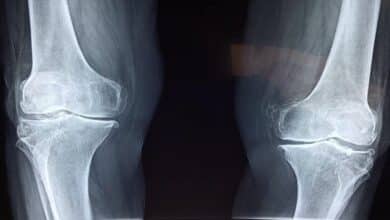 علاج غضروف الركبة بدون جراحة