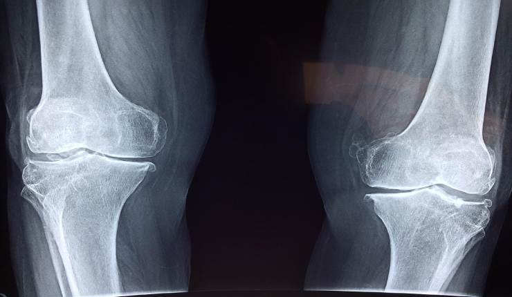 علاج غضروف الركبة بدون جراحة