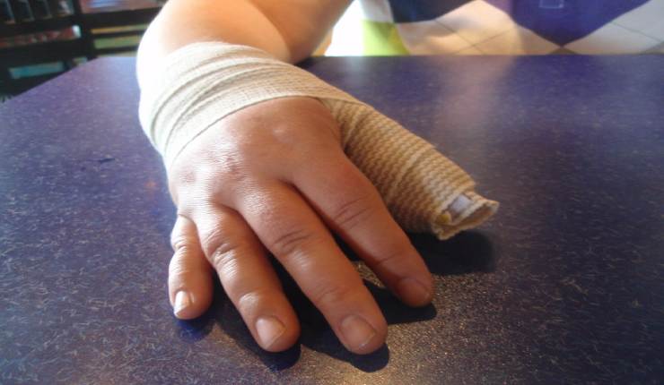 علاج تمزق أربطة إصبع الإبهام
