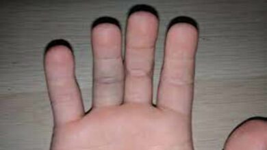 علاج رضة إصبع اليد