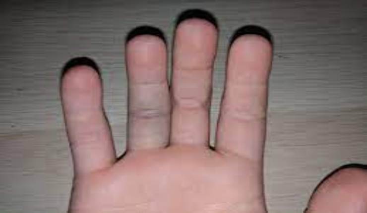 علاج رضة إصبع اليد